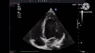 Hypertensive CMP due to fibromuscular dysplasia of renal artery [upl. by Elbertina663]