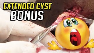 Extended Cyst Removal  Springtimes Bonus Video [upl. by Lorilee]