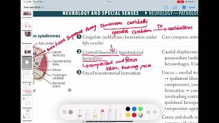 centraldownward transtentorial herniation neurology 149  First Aid USMLE Step 1 in UrduHindi [upl. by Templeton616]