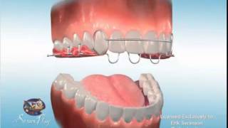 ES Ortho and AOB Anterior Open Bite Retainers [upl. by Casaleggio]