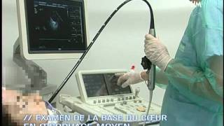 Echographie TransOesophagienne ETO  Film de formation [upl. by Odysseus]