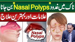 Gadood in Nose OR Nasal Polyps  Symptoms and Treatment of Nasal Polyps  Nose Polyps Ka ilaj [upl. by Carena]