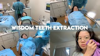 Extracting my Wisdom Teeth  Before During amp After [upl. by Oelak]