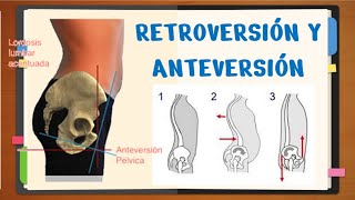 ✅RETROVERSIÓN Y ANTEVERSIÓN PÉLVICA ¿Qué es fácil [upl. by Cristabel]