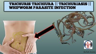 Know about Trichuris Trichiura TrichuriasisWhipworm parasite infection its lifecycle pathogenesis [upl. by Alviani]