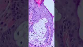 Demodex in a hair follicle incidental finding on skin biopsy pathology dermatology [upl. by Ettennyl]