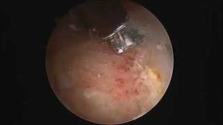 Hip Labral Tear debridement and Repair [upl. by Darsie243]