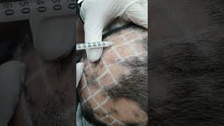 Demo19 Intralesional triamcinolone for alopecia areata [upl. by Nottarts]