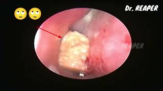 CASE NO 07  WHATS THIS THING INSIDE NOSE 😮  F B REMOVAL  NASAL ENDOSCOPY [upl. by Lucinda]