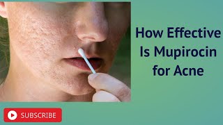 How Effective Is Mupirocin for Acne [upl. by Etezzil]