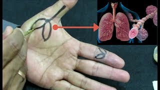 Bronchial Asthma  Try Sujok Acupressure for Instant ReliefCure Asthma Naturally [upl. by Veljkov35]