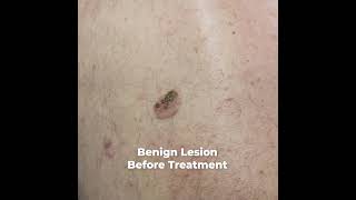 Benign Lesion Treatment Fotona Erbium Laser [upl. by Styles]