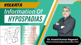 Complete Information about Hypospadias in Kolkata Hindi  वयस्क अधोमूत्रमार्गता  Dr Nagwani [upl. by Cresida]