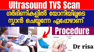 Ultrasound TVS Scan MalayalamPregnancy ScanWhen to Do TVS [upl. by Akilat]