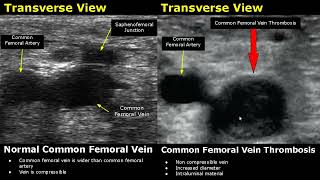 Femoral Vein Doppler Ultrasound Normal Vs Abnormal Image Appearances  Deep Vein Thrombosis USG Scan [upl. by Eelhsa227]