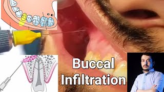 Local Anesthesia Buccal Infiltration Technique Maxillary Anesthesia Techniques dentistry [upl. by Anilac]