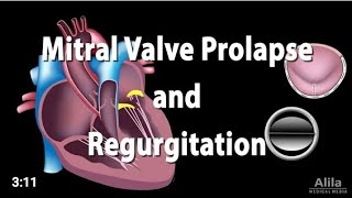 Mitral Regurgitation  كيف يتم اكتشاف شدتها باستخدام الإيكو [upl. by Constantine]