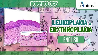 Leukoplakia and Erythroplakia  GIT Morphology  English [upl. by Edgard]