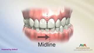 Orthodontic Treatment for Narrow Upper Jaw with Functional Shift  Expander or Spacer [upl. by Akcirret]