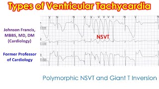 Types of Ventricular Tachycardia [upl. by Pratt]