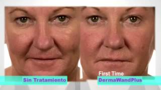 derma wand plus resultados [upl. by Corry538]