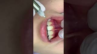 Infiltration anesthesia of the central incisors  Инфильтрационная анестезия центральных резцов [upl. by Ennaul]