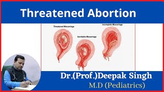 Threatened Abortion  Deepak PD Singh [upl. by Lenoj582]