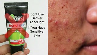 How To Remove Pimples With Using Garnier AcnoFight Face Wash [upl. by Win]