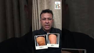 Dr Hasan August Cellulite Treatment [upl. by Dorothi691]