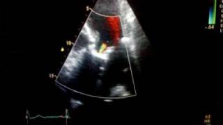 Aortic regurgitation combined with stenosis Ultrasound echocardiography [upl. by Danette]