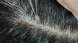 Relaxing dandruff removal w tweezers 15 02sleepyheads  visual ASMR oddlysatisfying [upl. by Myrilla]