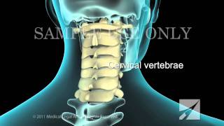 Lumbar Laminectomy [upl. by Steere]