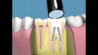 Tutti i passaggi della terapia canalare e della capsula dentale [upl. by Bussey]