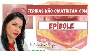 EPÍBOLE  FERIDAS NÃO CICATRIZAM COM EPÍBOLE [upl. by Enetsirhc39]