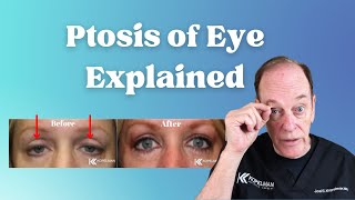 Ptosis of the Eye Explained  Eyelid Surgery for Droopy Eyelids [upl. by Coray]