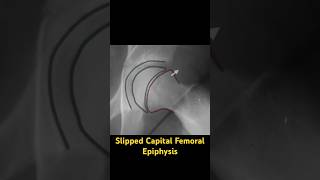 Slipped Capital Femoral Epiphysis Xray [upl. by Byrd]