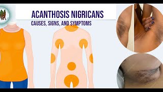 Acanthosis Nigricans Causes Signs and Symptoms [upl. by Htezil]