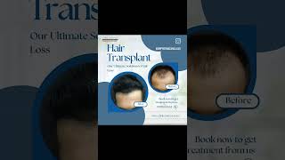 High Density Hair Transplant Results  Clinic Eximus shorts shortsfeed [upl. by Anyrtak]