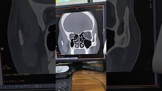 The Most EPIC Sinus CT Scan Youll Ever See radiology anatomy mri [upl. by Humpage311]