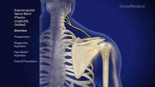 Suprascapular Nerve Block Fluoroscopically Guided  Pain amp Wellness Centers of Southern California [upl. by Indihar]