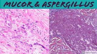 Mucormycosis amp Aspergillosis Angioinvasive Fungal Infection [upl. by Ayaladnot525]