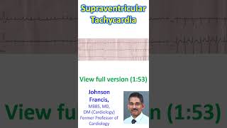 Supraventricular Tachycardia [upl. by Korfonta]