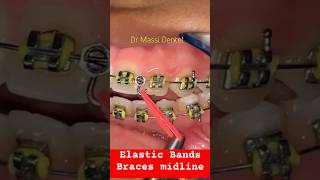 Elastic Bands  BRACES close the Gap [upl. by Robinia]