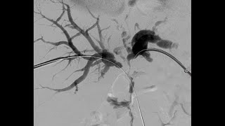 Percutaneous Transhepatic Cholangiography and Drainage PTCD [upl. by Rossie990]