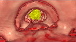 Foramen Magnum Meningioma [upl. by Sabanrab]