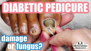 Diabetic Pedicure Toenail Damage or Nail Fungus [upl. by Ataner548]