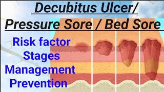 FON  Decubitus Ulcer Pressure Sore Bed Sore Pressure Ulcer NORCET AIIMS RRB nandanio4t [upl. by Ecirtac]