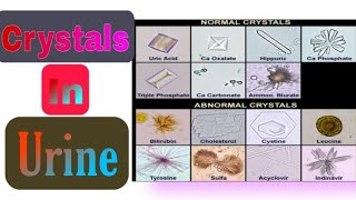 Crystals in Urine Normal amp Abnormal Crystals [upl. by Balsam]