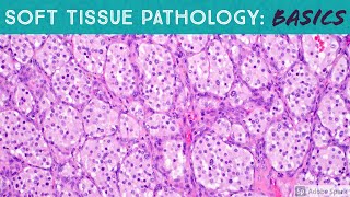 Basic Soft Tissue Pathology Cases Explained by a Sarcoma Pathologist [upl. by Eelrak]