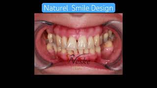 Naturel Smile design [upl. by Margo601]